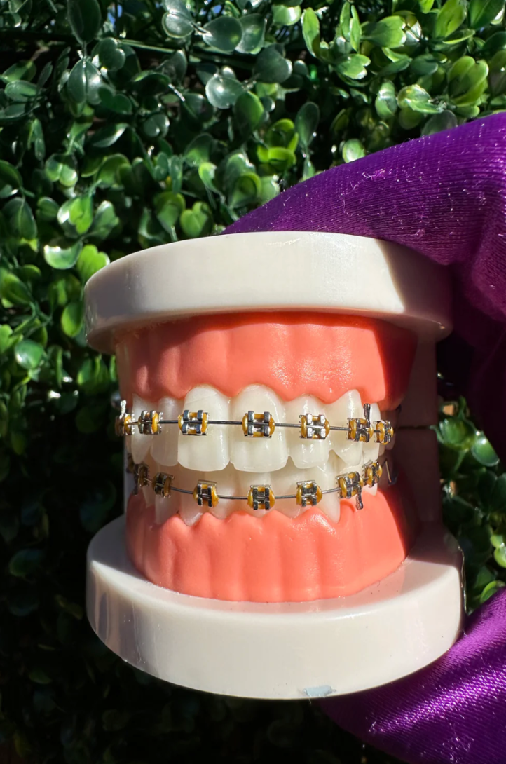 Clip-on Braces